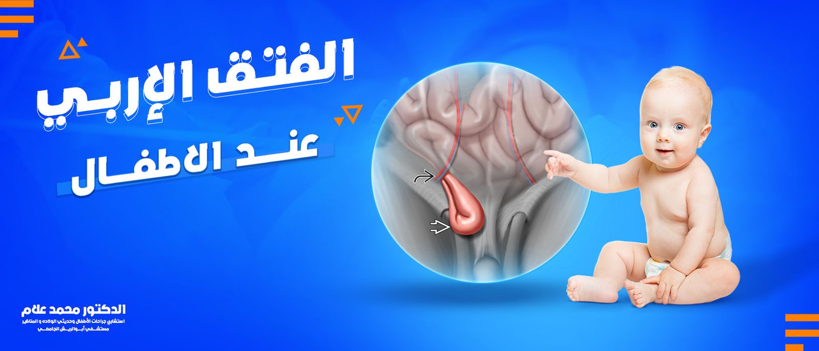 الفتق الاربي عند الاطفال وحديثي الولادة