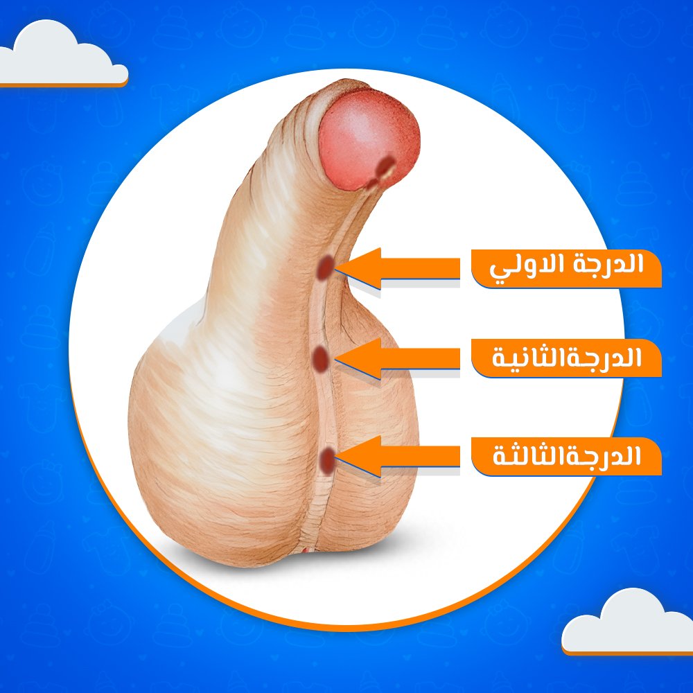 درجات الاحليل السفلي