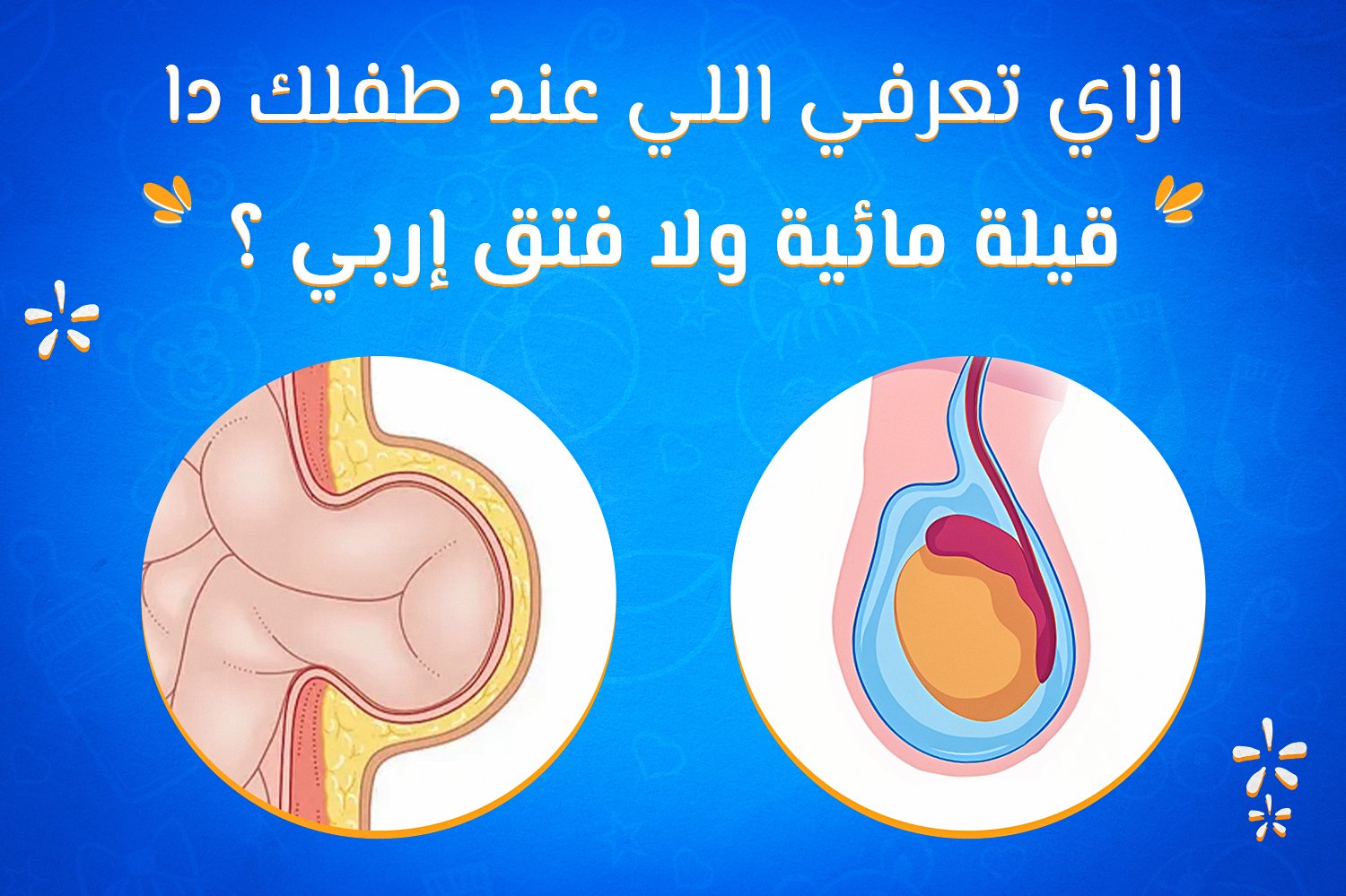  ازاي تعرفي اللي عند طفلك دا قيلة مائية ولا فتق إربي ؟  