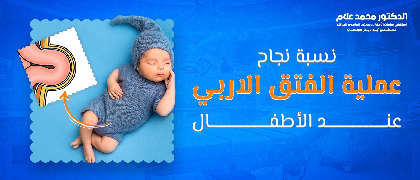 نسبة نجاح عملية الفتق الاربي عند الاطفال