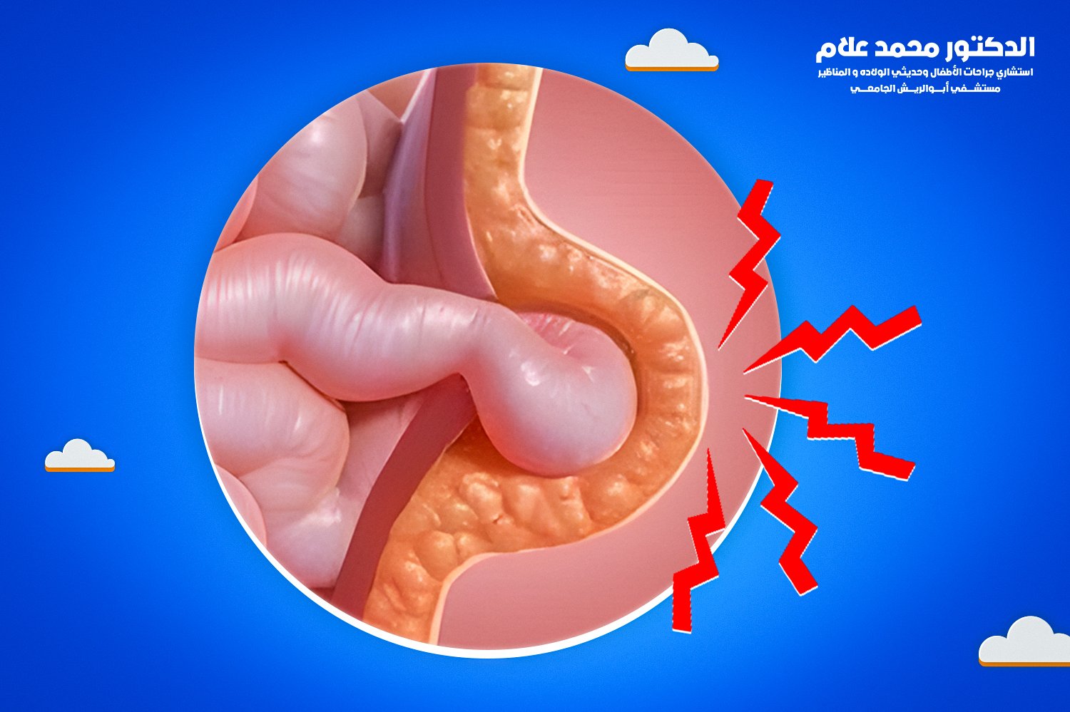  ختان الأطفال بجهاز الجومكو