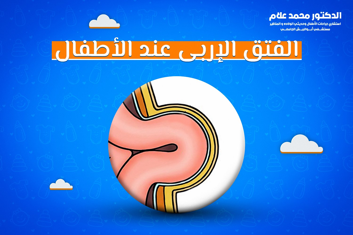 الفتق الإربى عند الأطفال