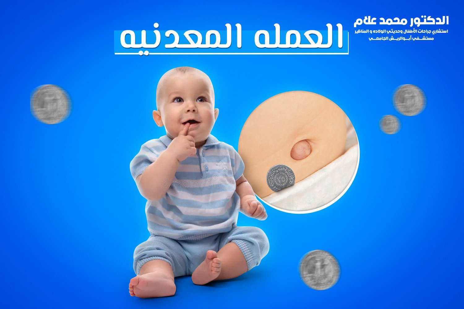 علاج الفتق السرى  عند الأطفال باستخدام العمله المعدنيه