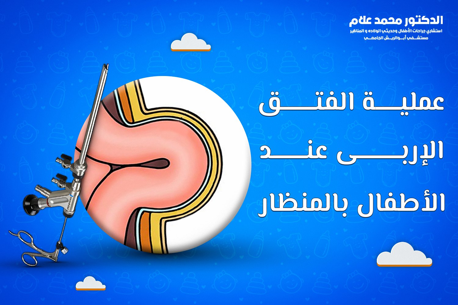 عمليه الفتق الإربى عند الأطفال بالمنظار