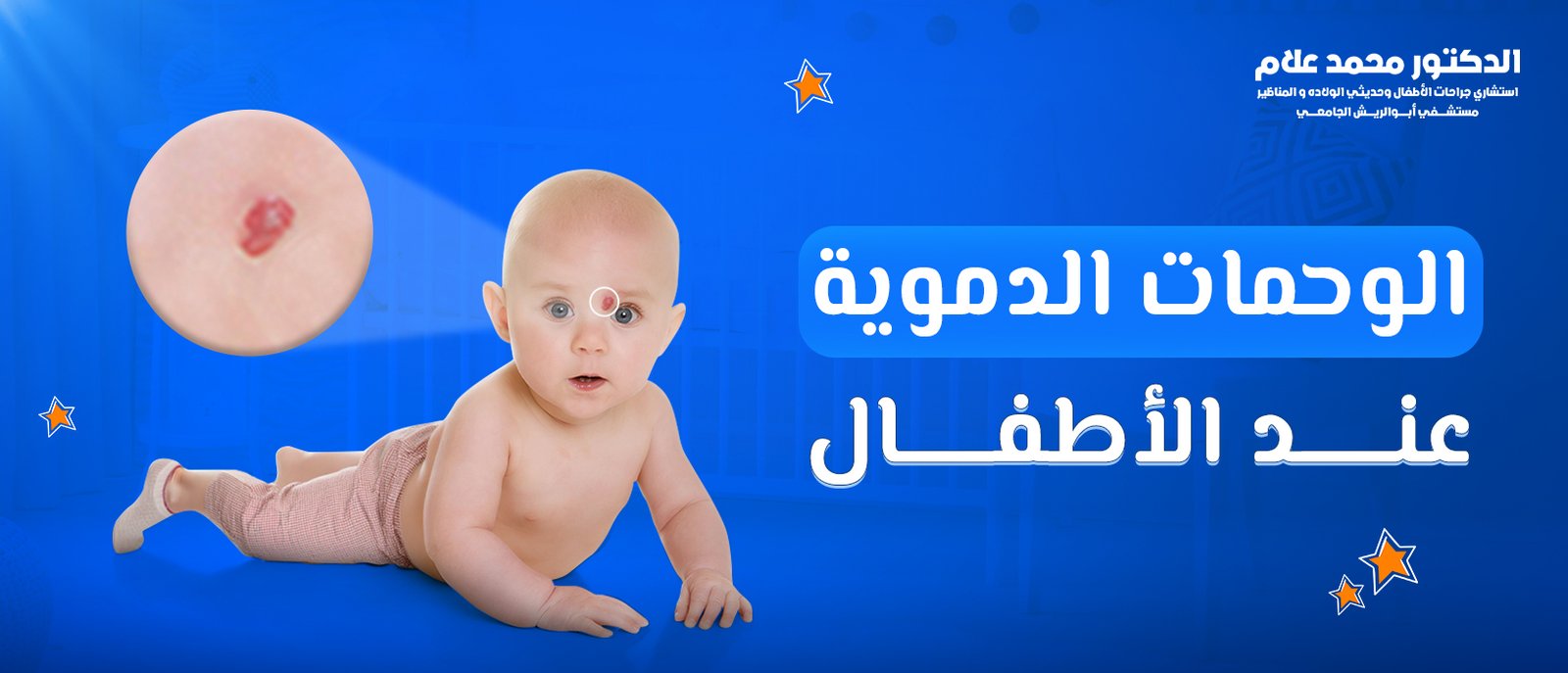 ​الوحمات الدموية عند الأطفال