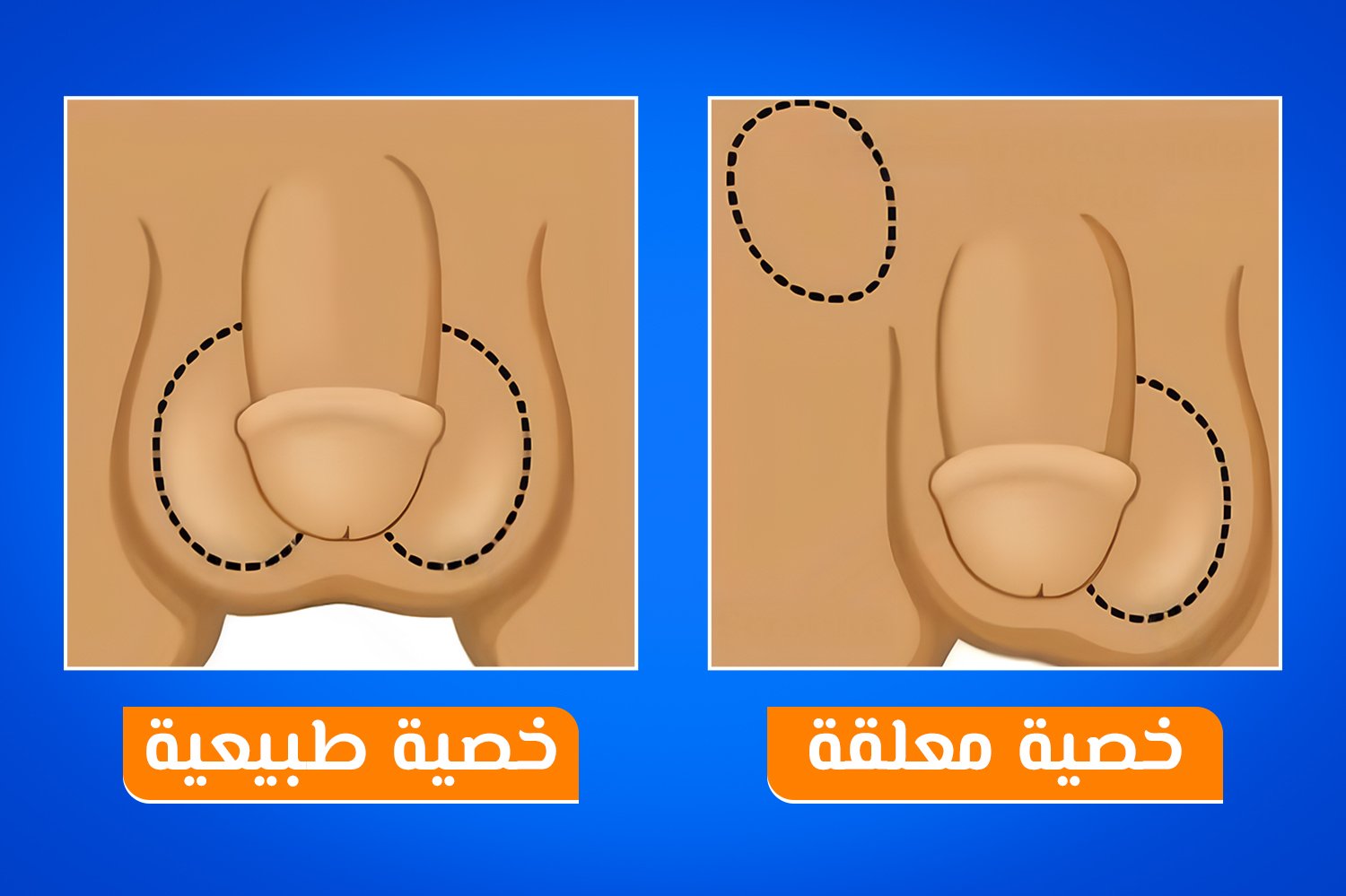 شكل الخصيه المعلقه عند الأطفال