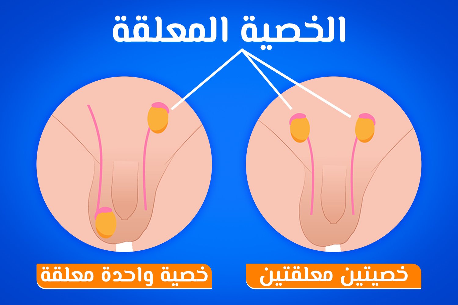 الخصية المعلقة عند الأطفال بالصور