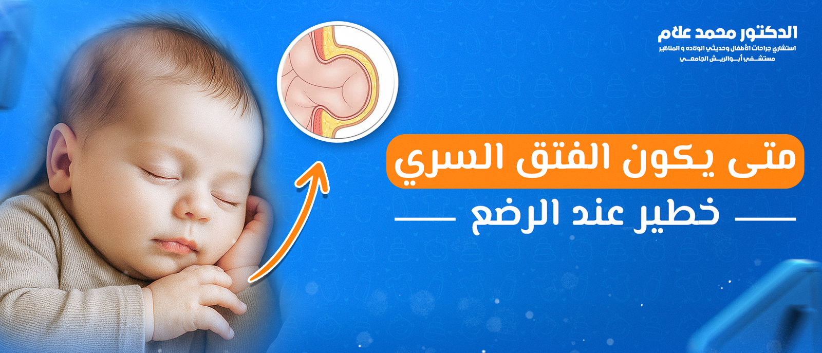 متى يكون الفتق السري خطير عند الرضع