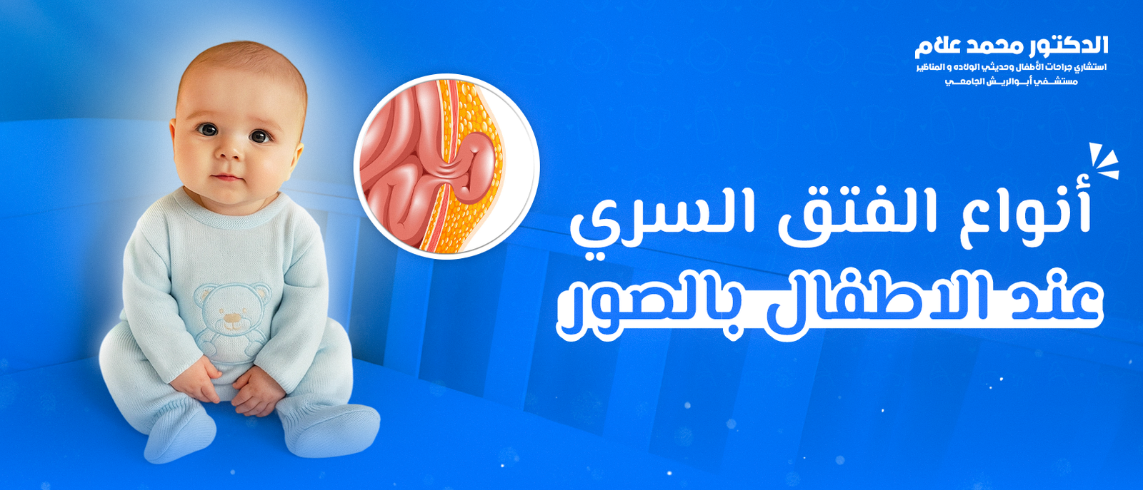 أنواع الفتق السري عند الأطفال بالصور